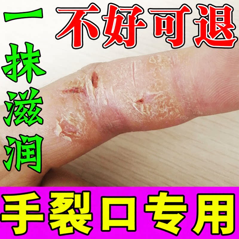 冶手裂的膏防开裂秋冬手指干裂开口掉皮痒疼手气手干裂专用膏