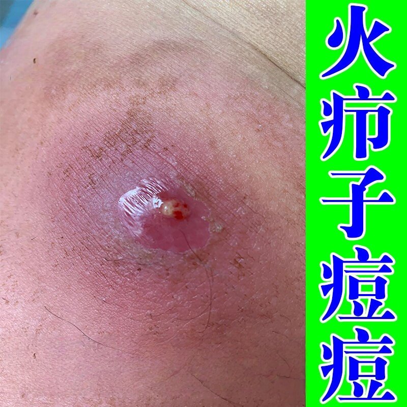火疖子拔脓膏治大人屁股上长火疖子痒起热疙瘩痒软膏