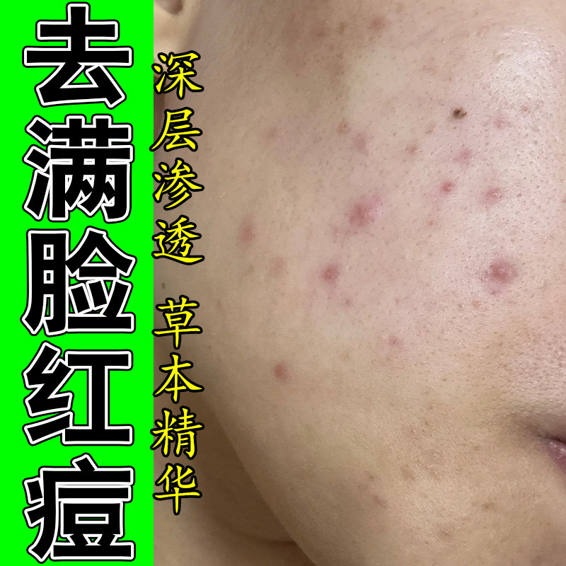 脸上红痘疙瘩起皮红肿硬块粉刺青春痘疙瘩粉刺植物萃取保湿乳霜