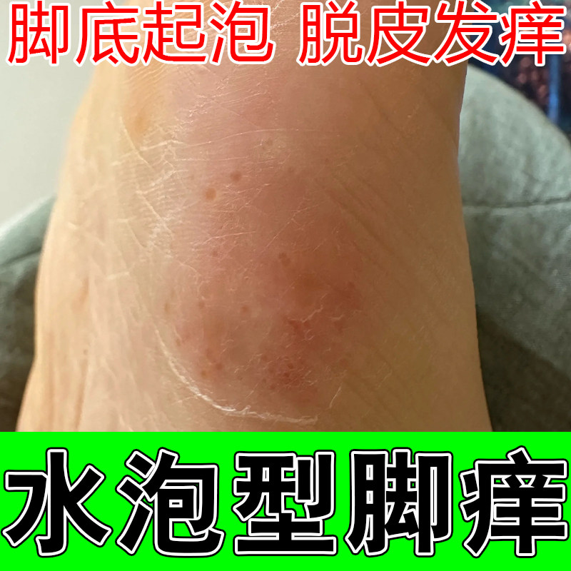脚底小水泡干痒红疙瘩起皮脚丫干燥粗糙红肿起屑修护保湿膏乳
