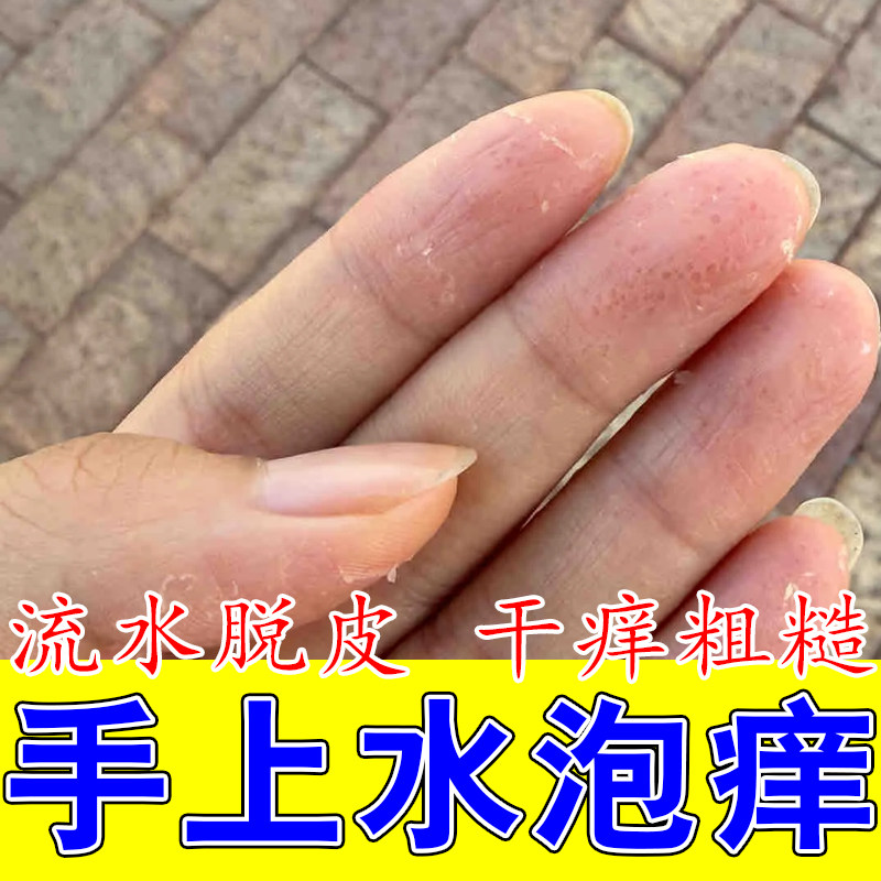冶手指透明水泡汗泡痒发疙瘩小颗粒疙瘩手出汗多发痒起皮干燥膏