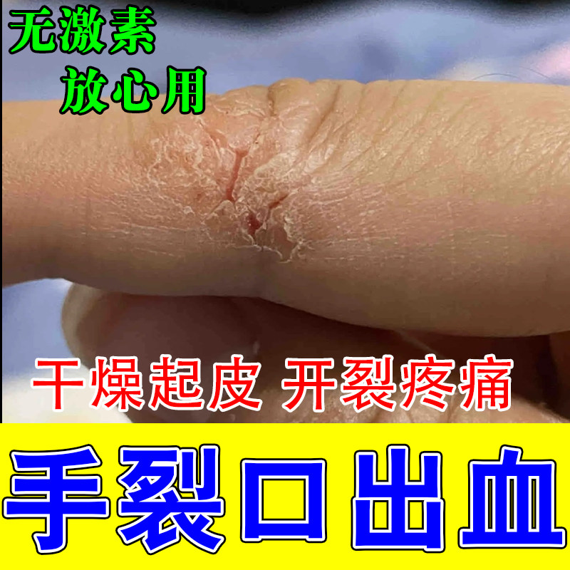 手裂口子干燥粗糙爆干皮手指头脱皮掉屑疼起硬皮红肿保湿修护膏