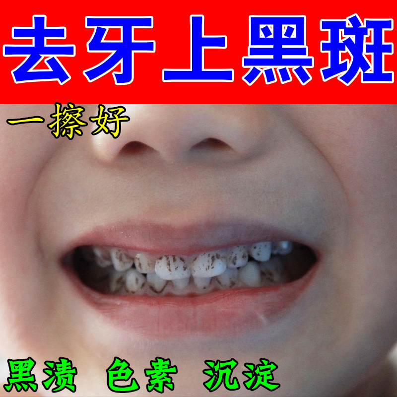 牙黑斑洞牙窝沟牙表面黑渍改善牙齿黑线牙渍黑线明显修护清洁液
