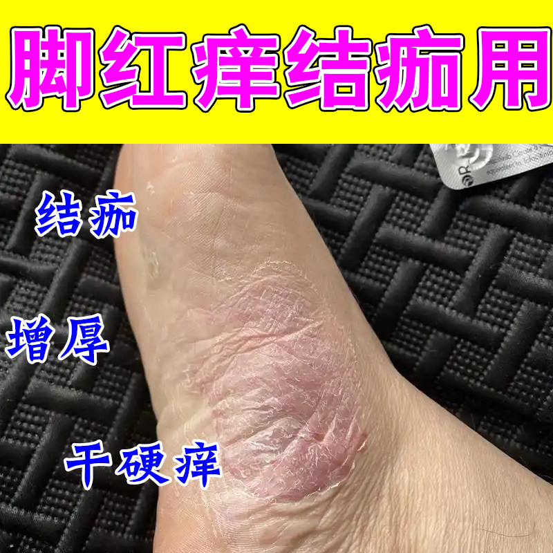 冶脚底侧干痒脱皮红神经痒脚侧痒刺挠粗糙疙瘩起皮干痒修护膏