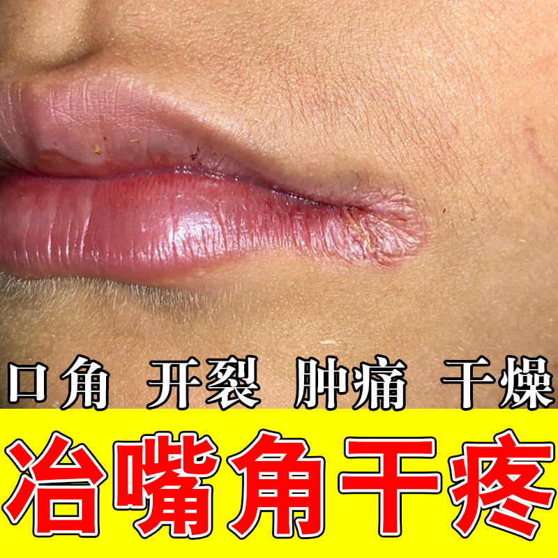 口周干上火疼唇嘴唇周围一圈红斑干裂脱皮嘴巴过敏起皮嘴角上火疼