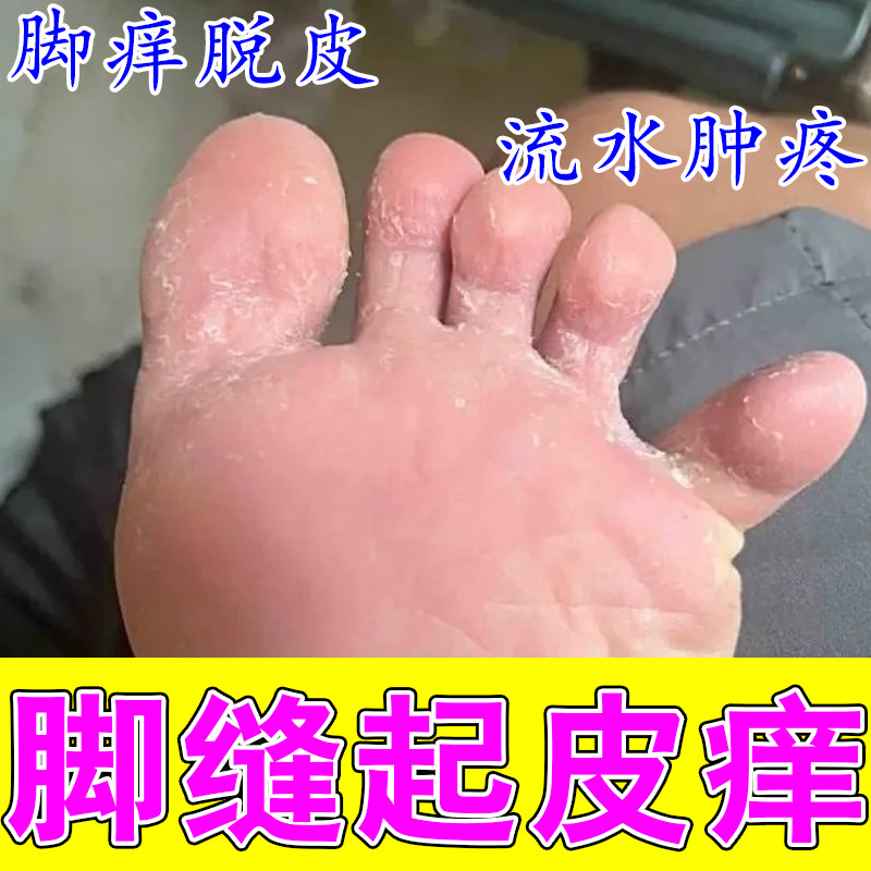 脚缝脱皮痒膏专用起皮手丫手指间发红痒开裂脱皮分离修复草本膏