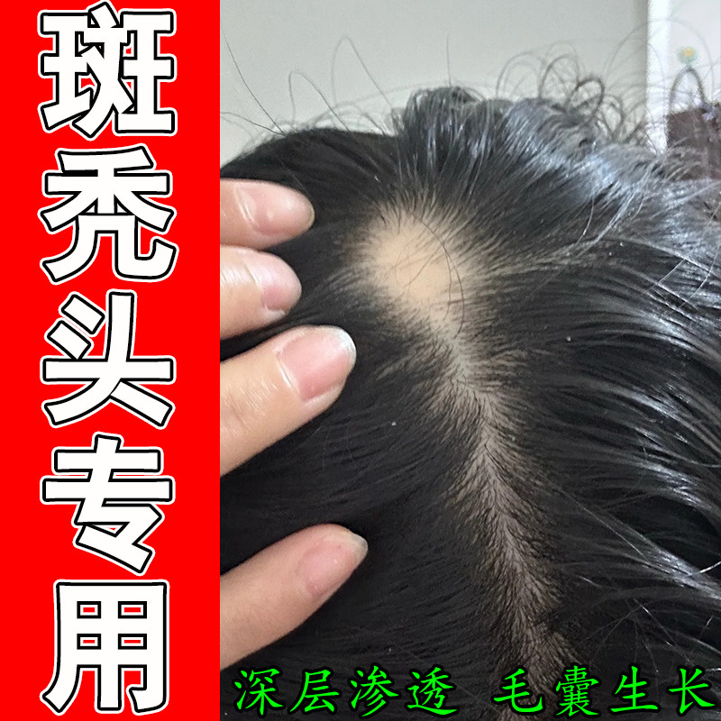 头顶斑秃掉发多后脑勺光秃滋养头皮固发发量单薄草本育发修护喷剂
