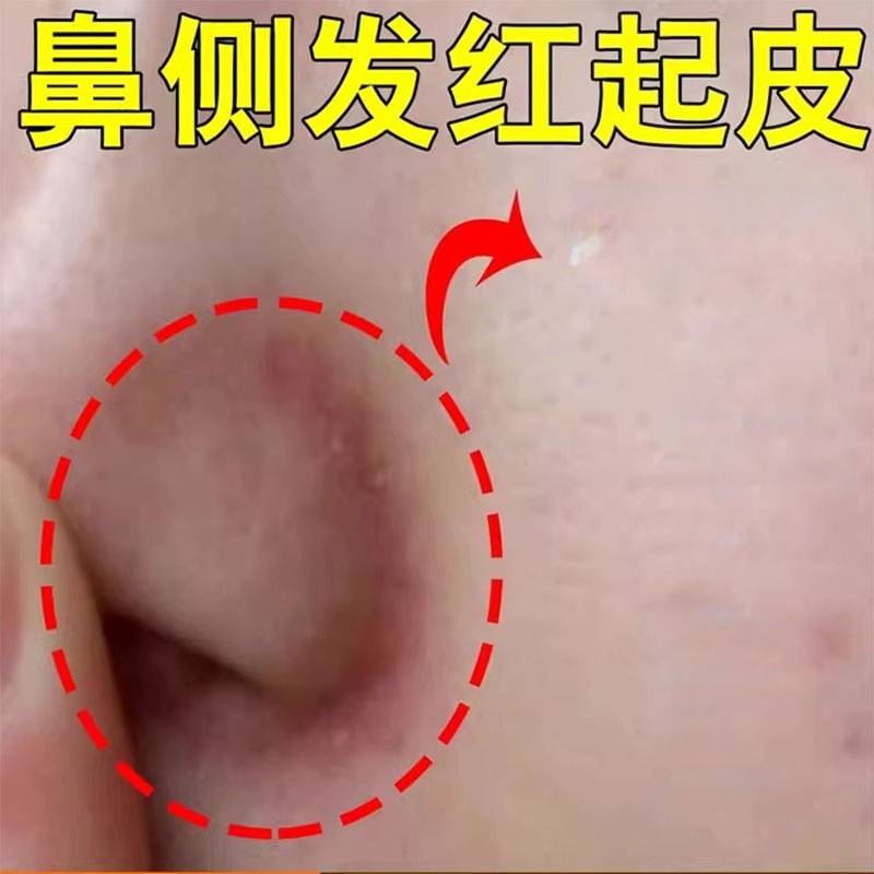 鼻子两侧起皮脱皮发红鼻翼两边泛红干燥修复长痘痘痒膏酒糟鼻