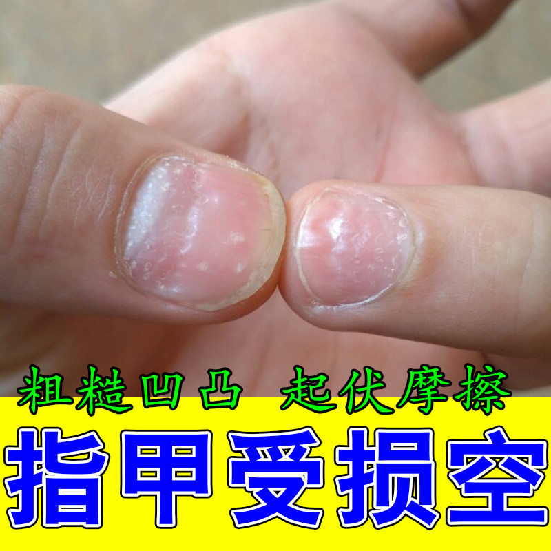 指甲修复液指甲盖凹凸不平凹陷凹坑厚甲啃咬甲萎缩甲受勋再生长液