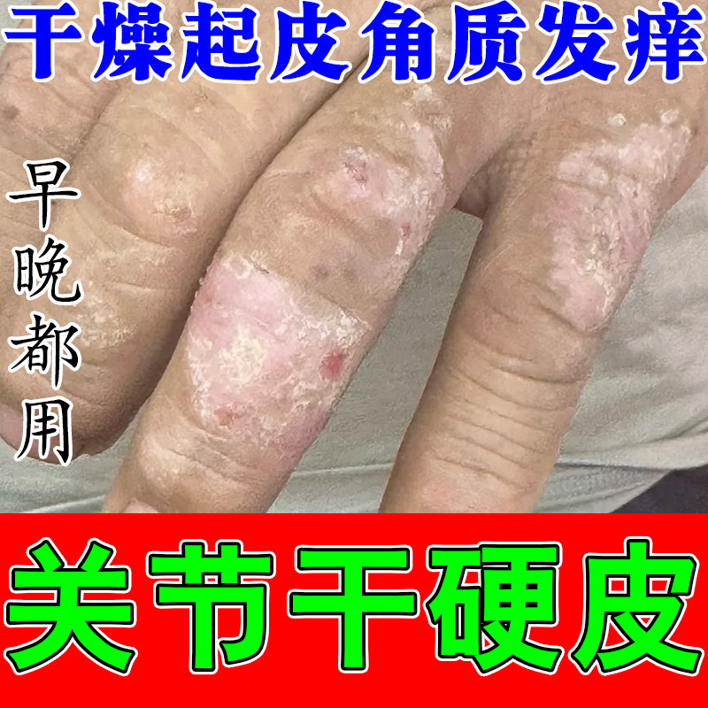 手指关节真菌手指关节长硬疙瘩粗糙脱皮手真菌硬块结痂修护保湿膏