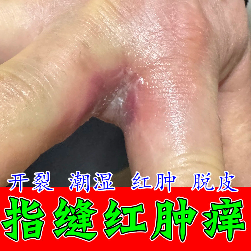 手指缝脱皮痒膏专用起皮手丫手指间发红痒开裂脱皮分离修复草本膏