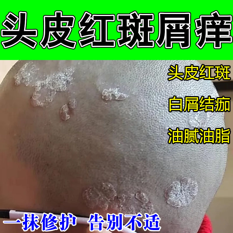 头皮红斑起屑大片鳞屑干燥发痒红肿结痂头部干燥粗糙植物萃取软膏
