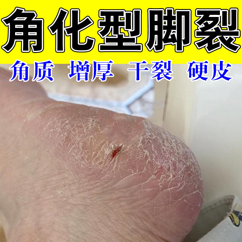 足跟开裂爆皮厚增角质增厚手脚粗糙掉皮干裂草本滋养修复滋润膏