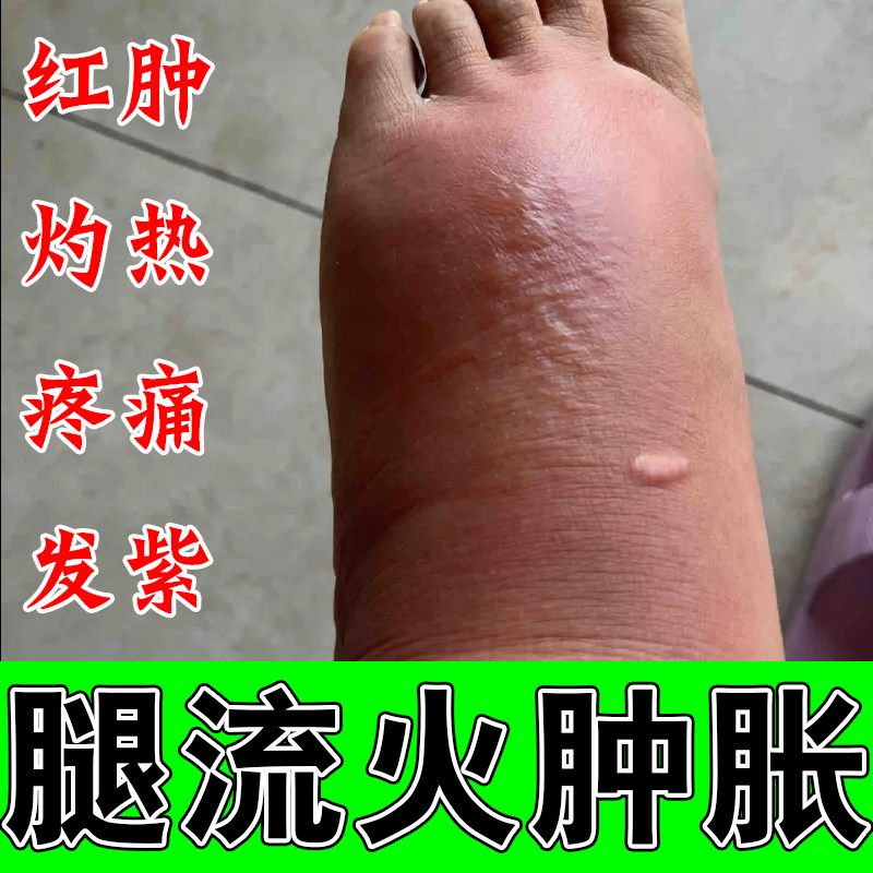 小腿下肢泛红大面积脚脖子疼痛肿胀灼热流火皮肤消肿灼热草本膏