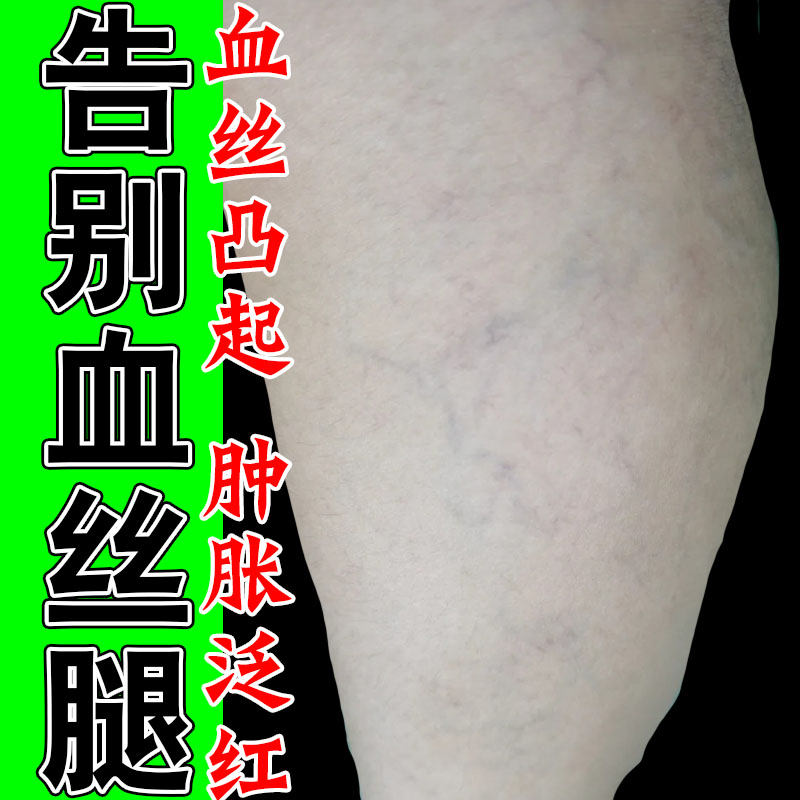 严重腿上血管扩张红血丝腿上红血丝青筋凸起血管扩张草本修护乳膏