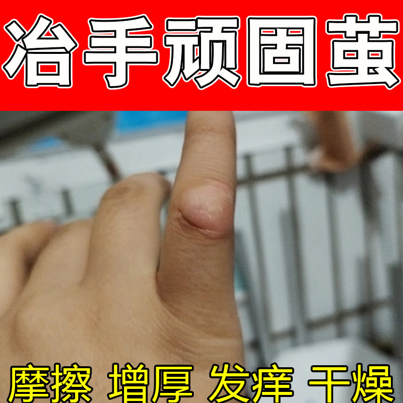 去手指关节茧块增厚垫手指关节硬疙瘩粗糙关节柔硬滋养指节垫膏