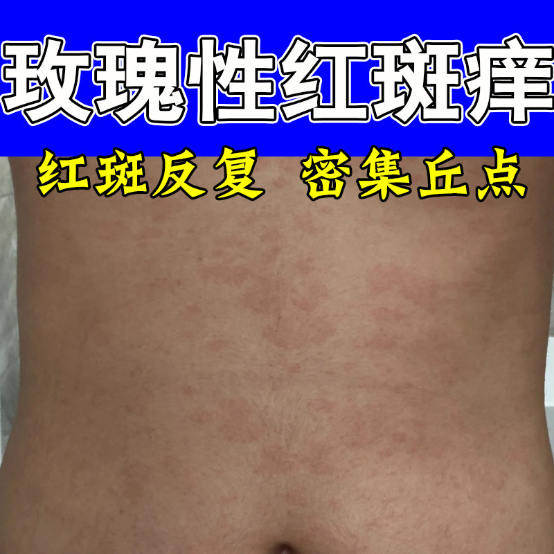 顽固玫瑰性红斑身上胸口皮肤红痒红点红斑过敏干痒过敏修护保湿膏