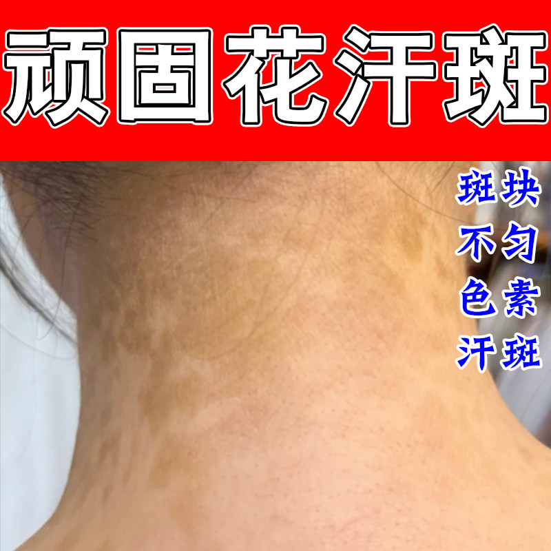 汗斑专用乳膏去腋下花斑白斑抑全身前胸后背皮肤汗斑多草本膏