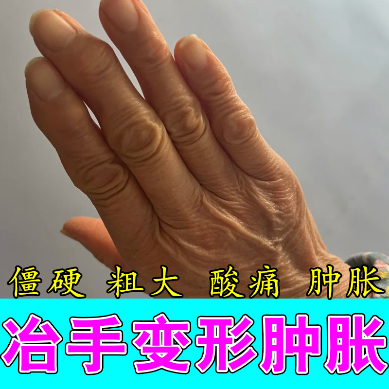 手指粗大鼓包修护膏缓解老人手指僵硬疼痛活动受限草本养护膏