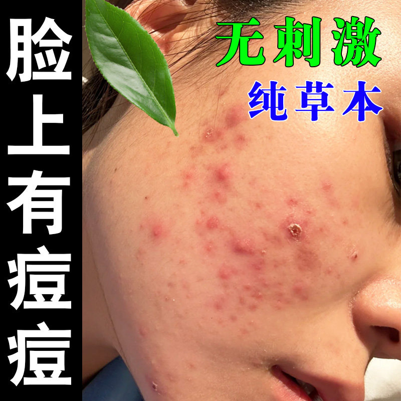 脸上起学生青春红肿有闭口粉刺去淋巴痘腮帮子脸颊两边