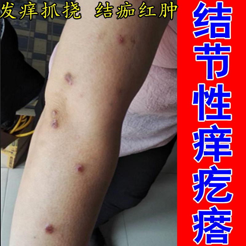 结节性疙瘩红肿痒红硬疙瘩胳膊小腿痒身上起红疙瘩痒舒缓草本膏
