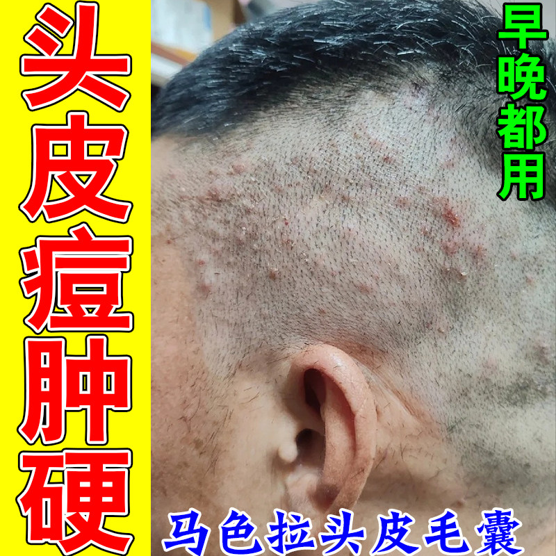 头皮疙瘩疼红肿长痘头皮毛囊冶后脑勺有疙瘩起红肿硬块草本舒缓膏