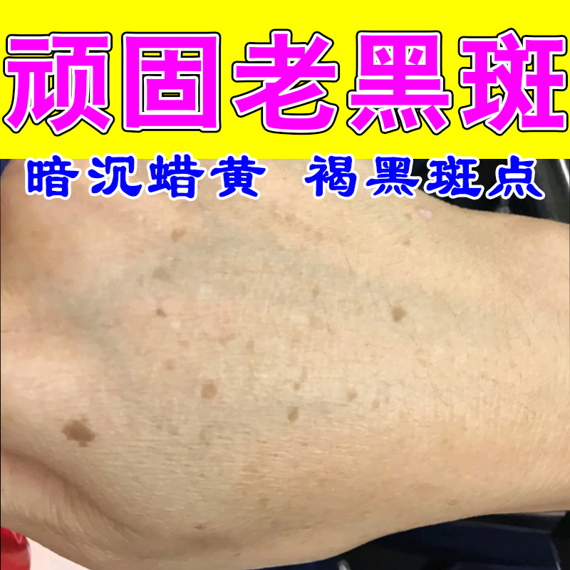 老年脸上斑脸部手部黑斑晒斑黄斑雀斑黑板皮肤修护白均匀草本膏
