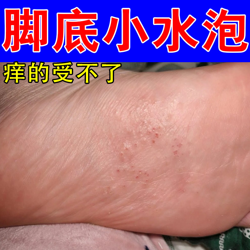 脚底小水泡干痒红疙瘩起皮脚丫干燥粗糙红肿起屑修护保湿膏乳
