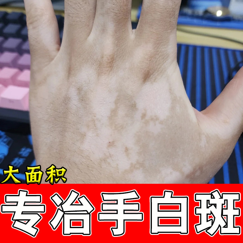 手上白斑专用遮盖膏修复手背长白色斑块促进黑色素生长补骨脂软膏