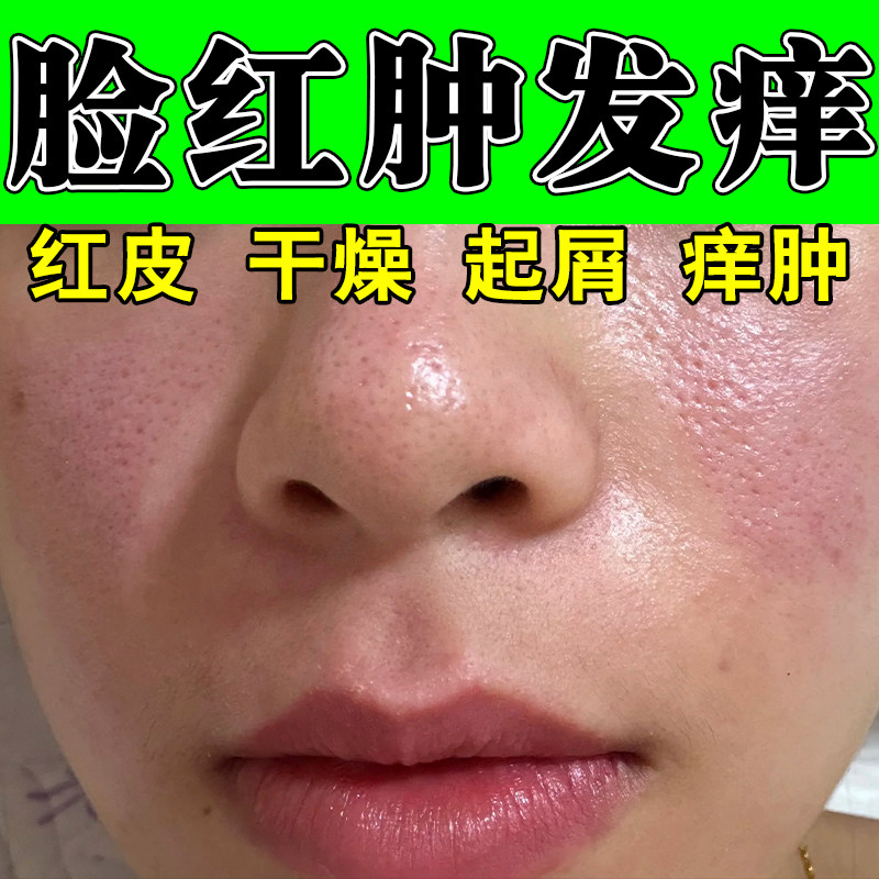 冶面部换季泛红干痒红肿刺痛春秋肌肤敏感发烫干燥痒红肿敏感膏