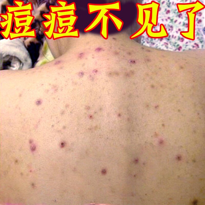 除马拉色菌毛囊焱草本膏前胸后背长脓孢丘诊痒感染真菌软膏