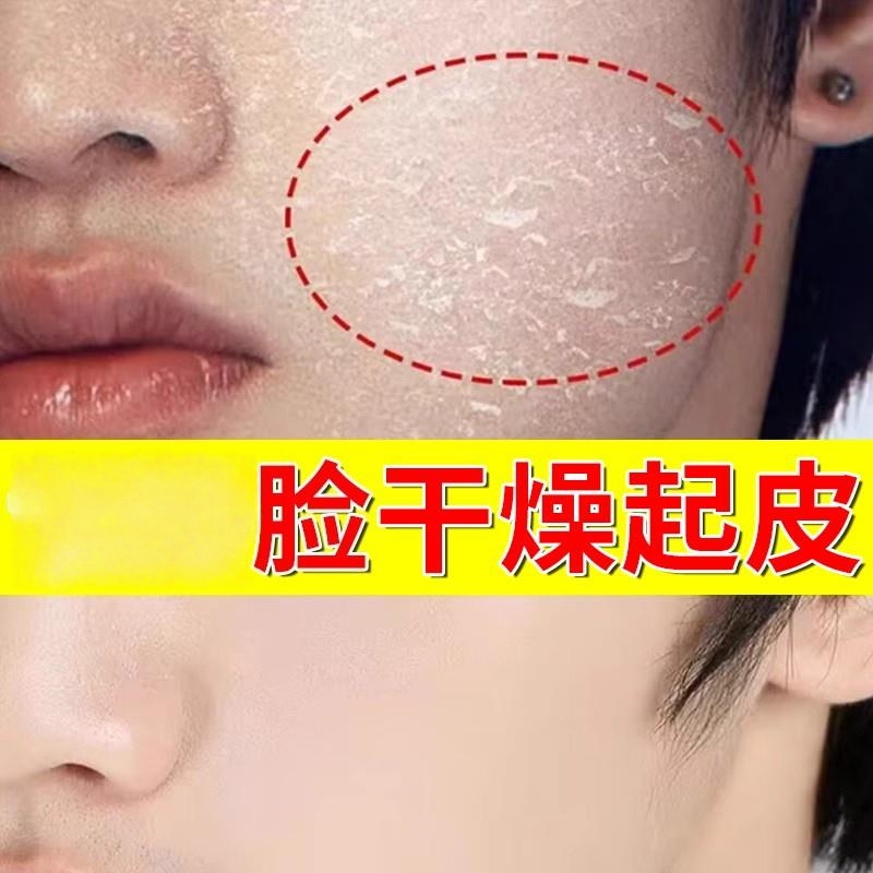 脸面霜干燥起皮滋润保湿皮肤补水爆皮女士脸上掉皮男春秋冬修护霜