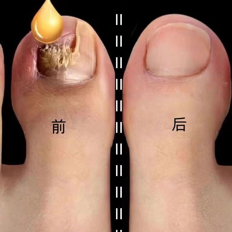 【爆款热卖】滴一滴 祛除99%脚趾真菌！！