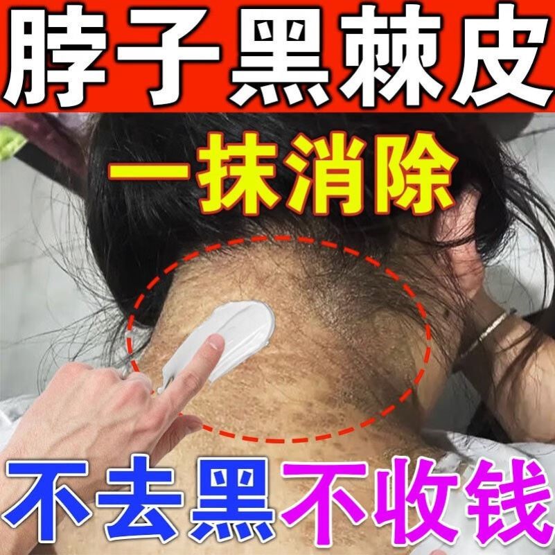 脖子黑黑的黑棘皮症去除儿童黑色素沉淀神器脖子后面洗不干净美白