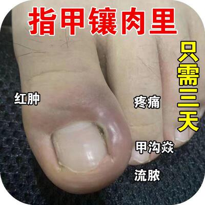 甲沟炎治疗专用膏嵌甲去除息肉矫正器去脚趾甲往肉里长甲勾特效药