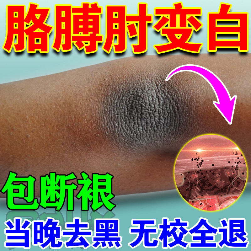胳膊肘去黑皮肤黑色素沉淀去除死皮手关节腋下黑印磨砂膏美白神器
