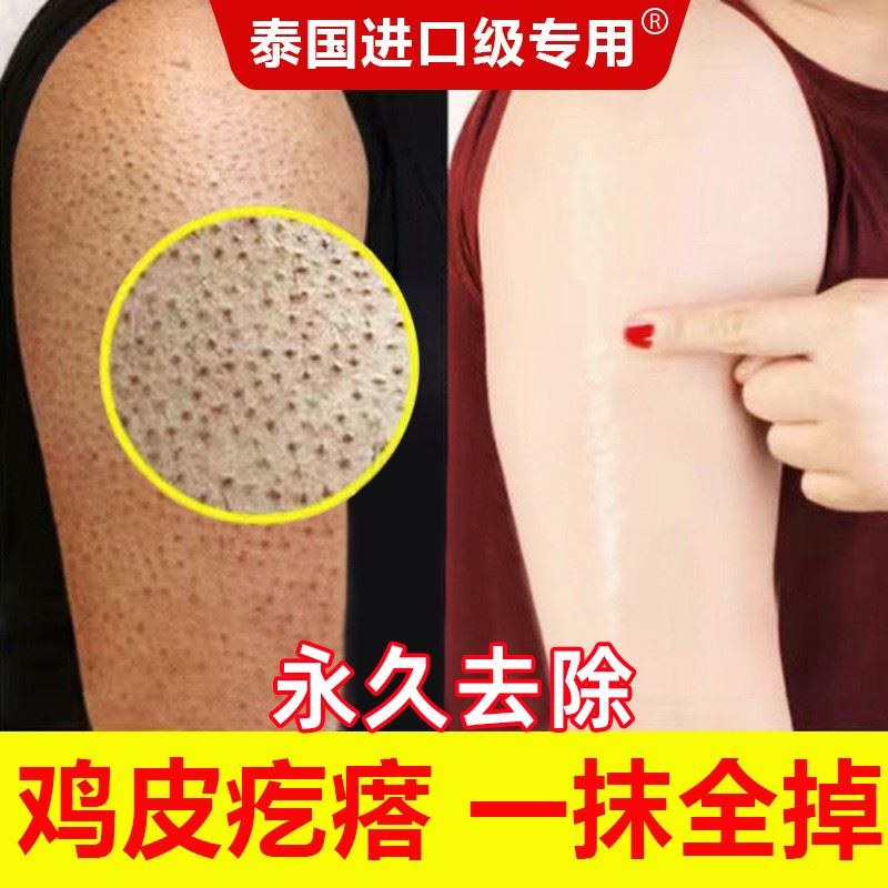 鸡皮肤疙瘩毛囊角化药毛周角化症鱼鳞皮肤霜腿上胳膊小疙瘩毛囊炎