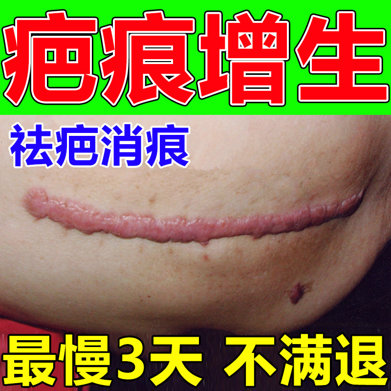 疤痕修复除疤膏妊娠纹修复霜痘印增生去疤膏剖刨腹产疤痕修复凝胶
