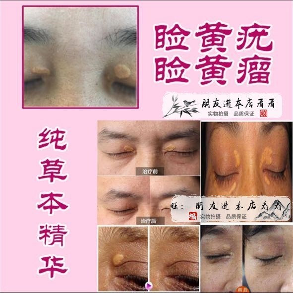 草本修护膏去除眼睑黄瘤膏睑黄疣祛汗管瘤药眼皮脸黄斑瘤睑眼皮周