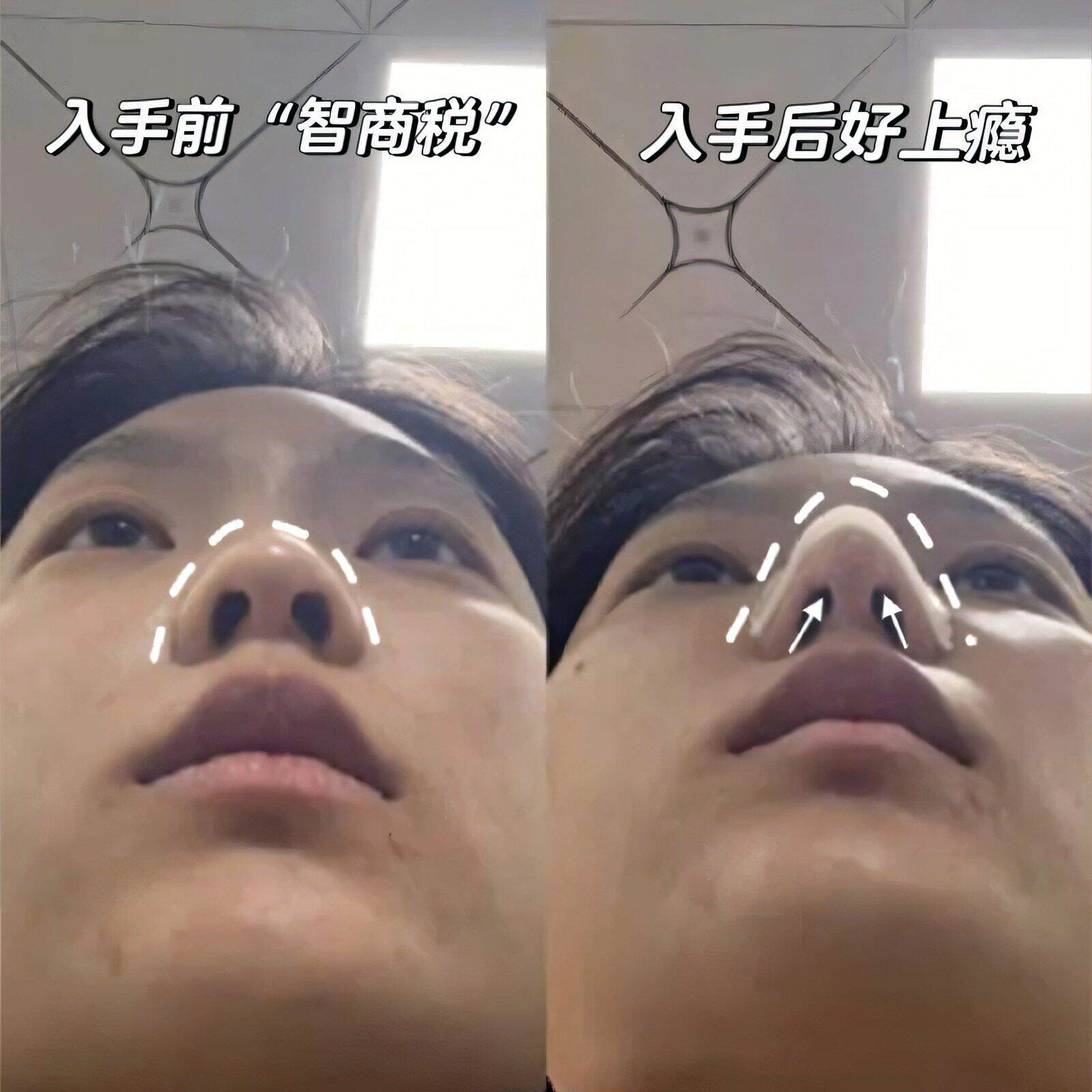 小红书同款!低温热塑鼻夹板医美术后矫正板固定塑型板缩小鼻孔