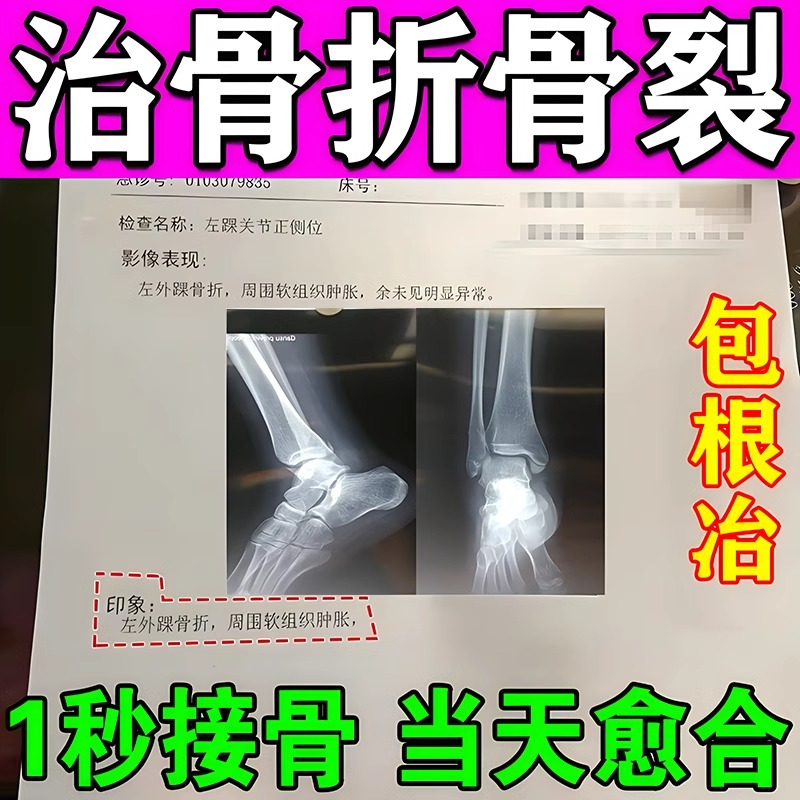 骨折骨裂恢复药快速接骨