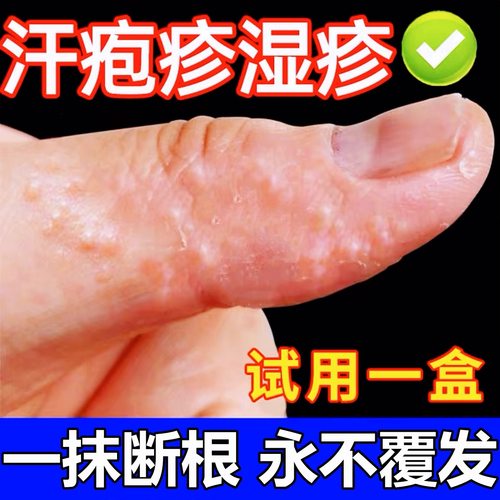 汗手指上脚水泡专治脱皮干裂