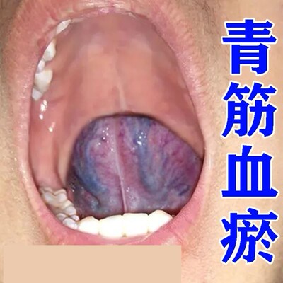 舌下青筋舌头底又黑又粗淤血疏通血管怒张严重紧挨舌下脉气血虚弱