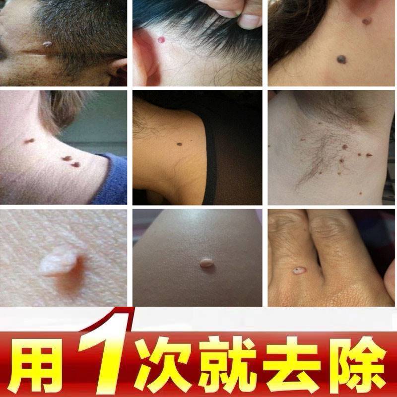 去猴子脖子丝状疣腋下肉粒疙瘩肉揪的药膏肉丁鱼鳞痣