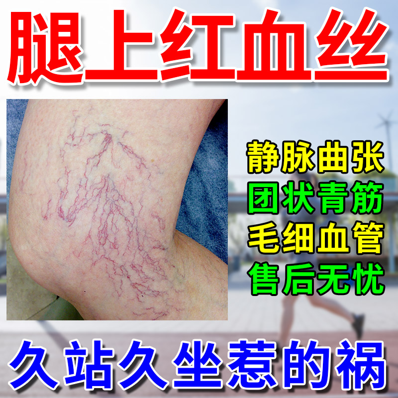 【女性专用】去腿上红血丝