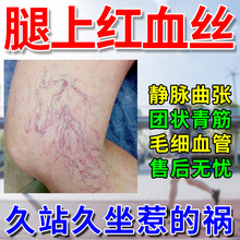 去除女性腿上有红血丝静脉曲张冷敷凝胶消痛膏毛细血管修复专药膏