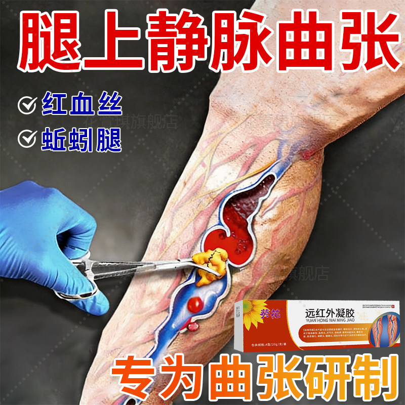 静脉曲张腿部冷敷凝胶专用腿上红血丝腿部精索曲张血管肿青筋凸起