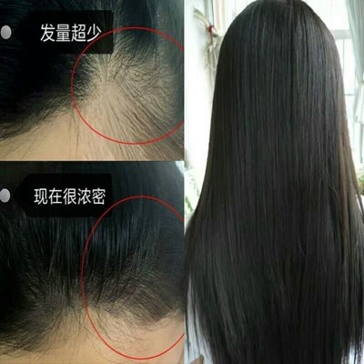 头发增长液生发剂快速短发变长发留长神器加快生长浓密增发营养水