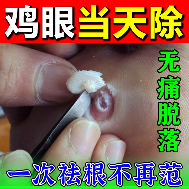 鸡眼液治疗足疣跖疣肉刺去手上脚上鸡眼瘊子非膏药贴皮肤抑菌液
