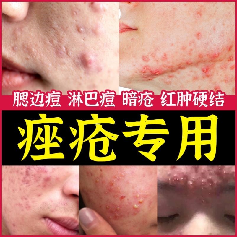 草本祛痘玫瑰痤疮祛痘重度暗疮脸部下巴淋巴腮边痘红肿硬块腮帮子